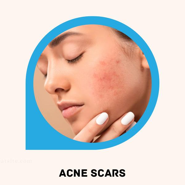 Acne